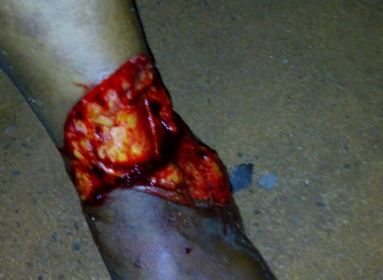 injury